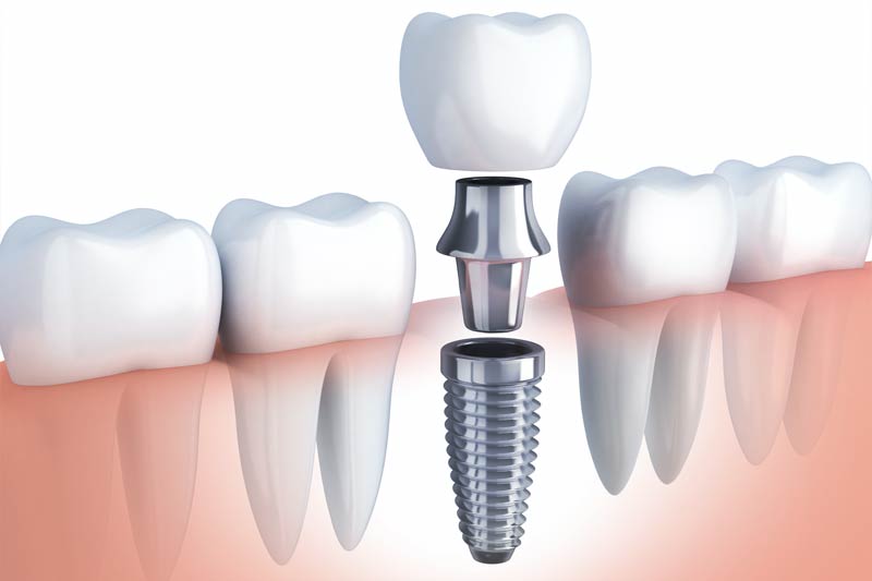 Dental implant planning at Astra Dental