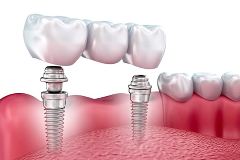 Dental implant appointment at Astra Dental