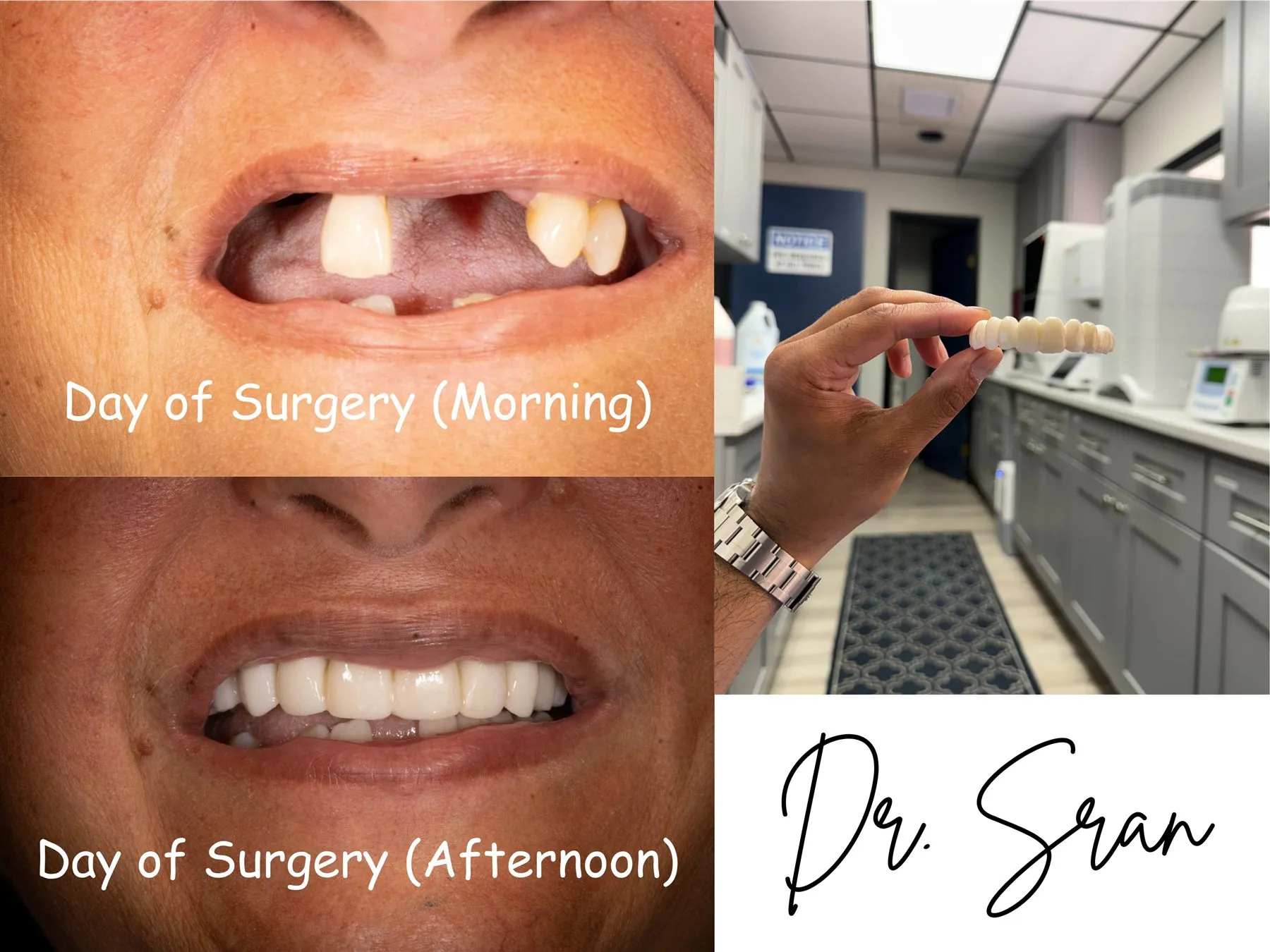 Day-of-surgery full-arch case case photo from Astra Dental