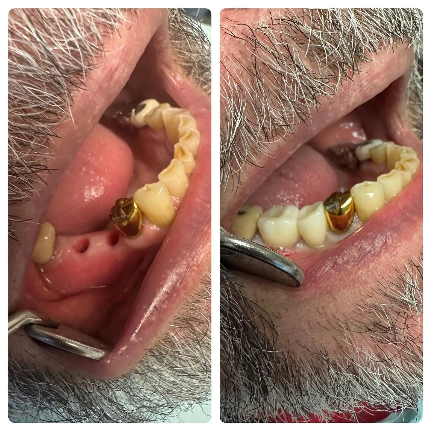 Single Tooth Implant at Astra Dental in Stratford, CT