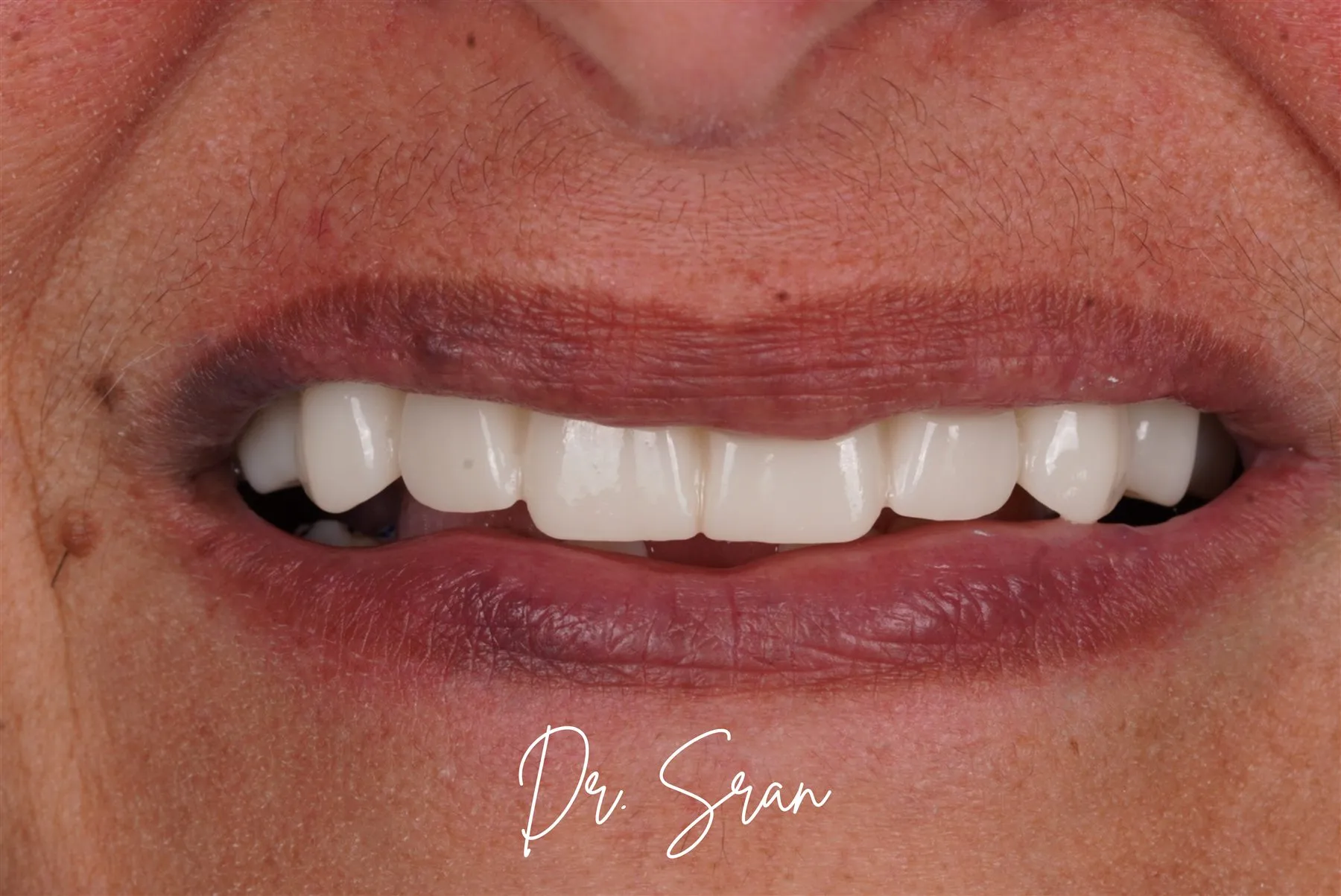 Final implant smile case photo from Astra Dental