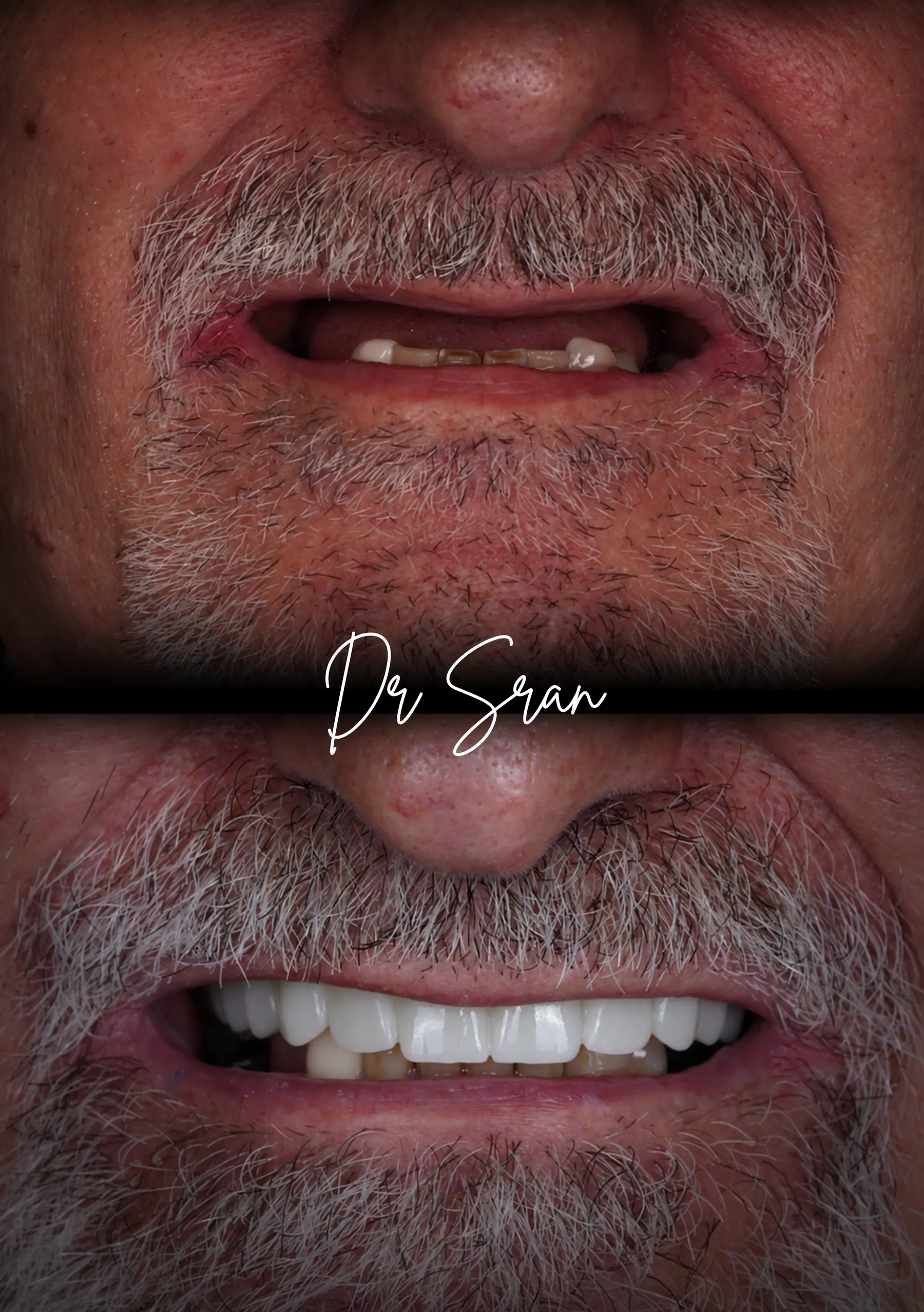 Dental Implants at Astra Dental in Stratford, CT