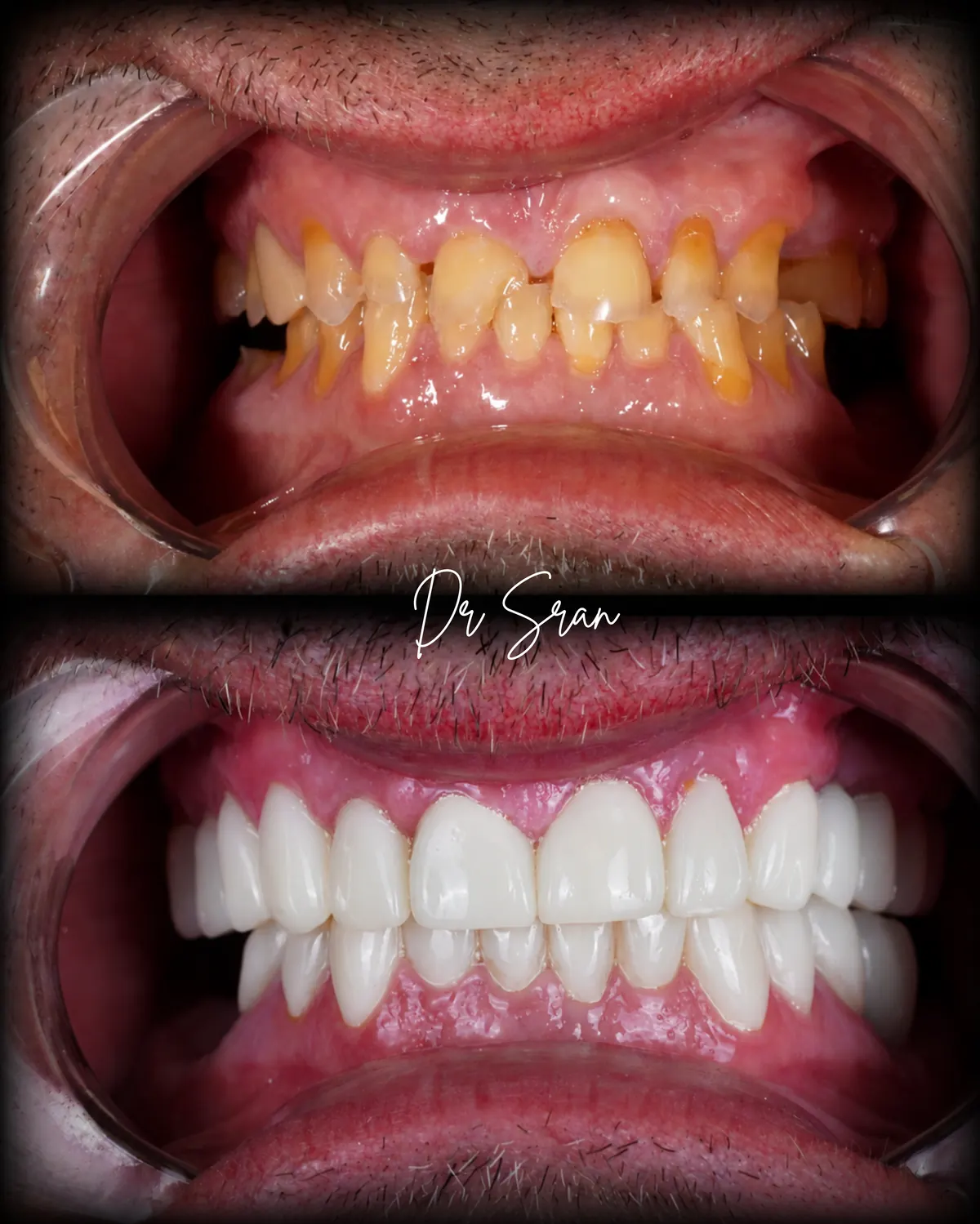Full mouth reconstruction before and after result by Dr. Sran at Astra Dental