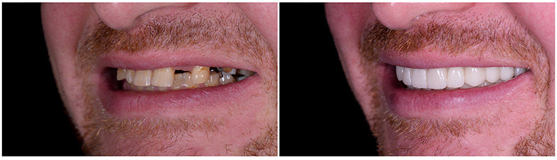 Dental Implants at Astra Dental in Stratford, CT
