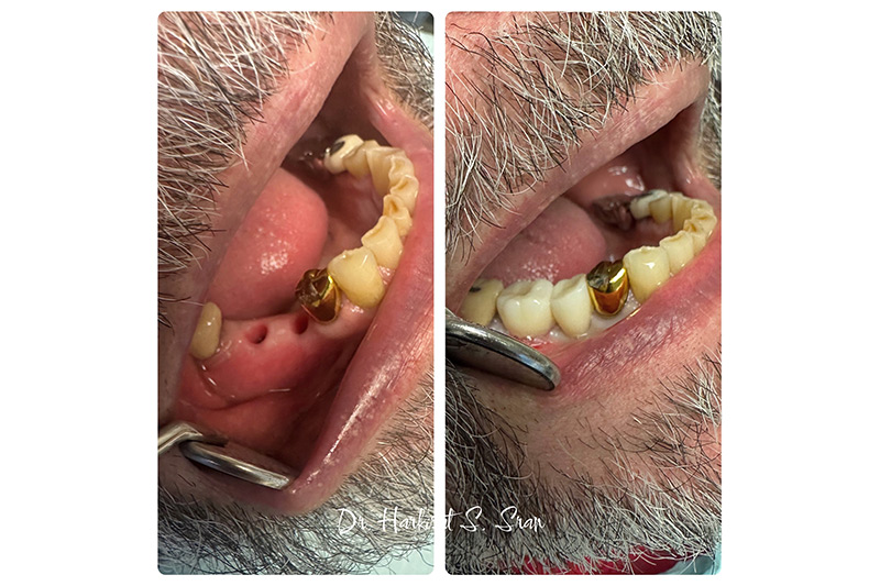 Dental implant restoration planning at Astra Dental