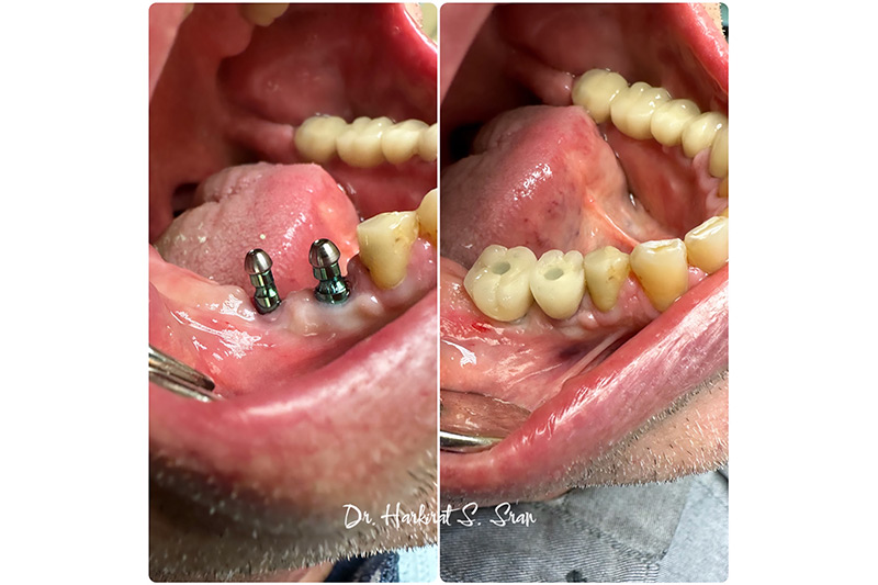 Dental implant technology at Astra Dental Stratford