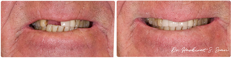 Dental implant patient care at Astra Dental