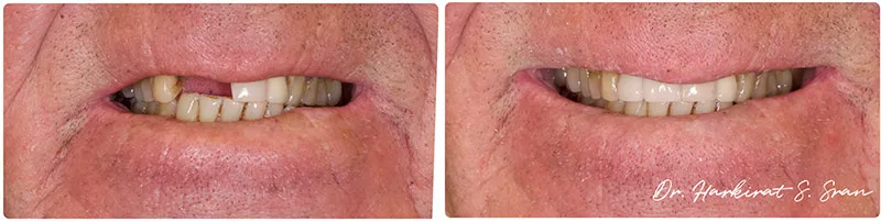 All-on-X Implants at Astra Dental
