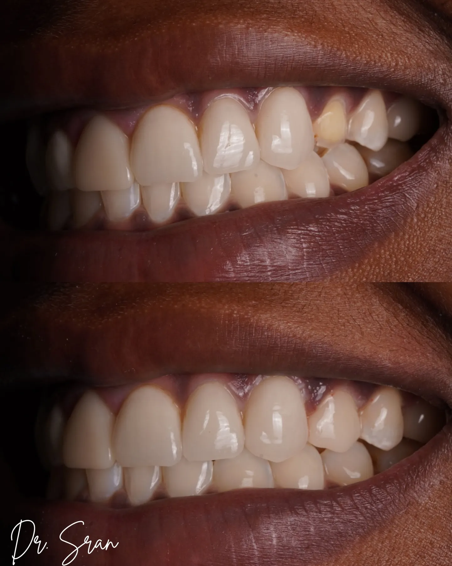 Same-day veneer repair case photo from Astra Dental