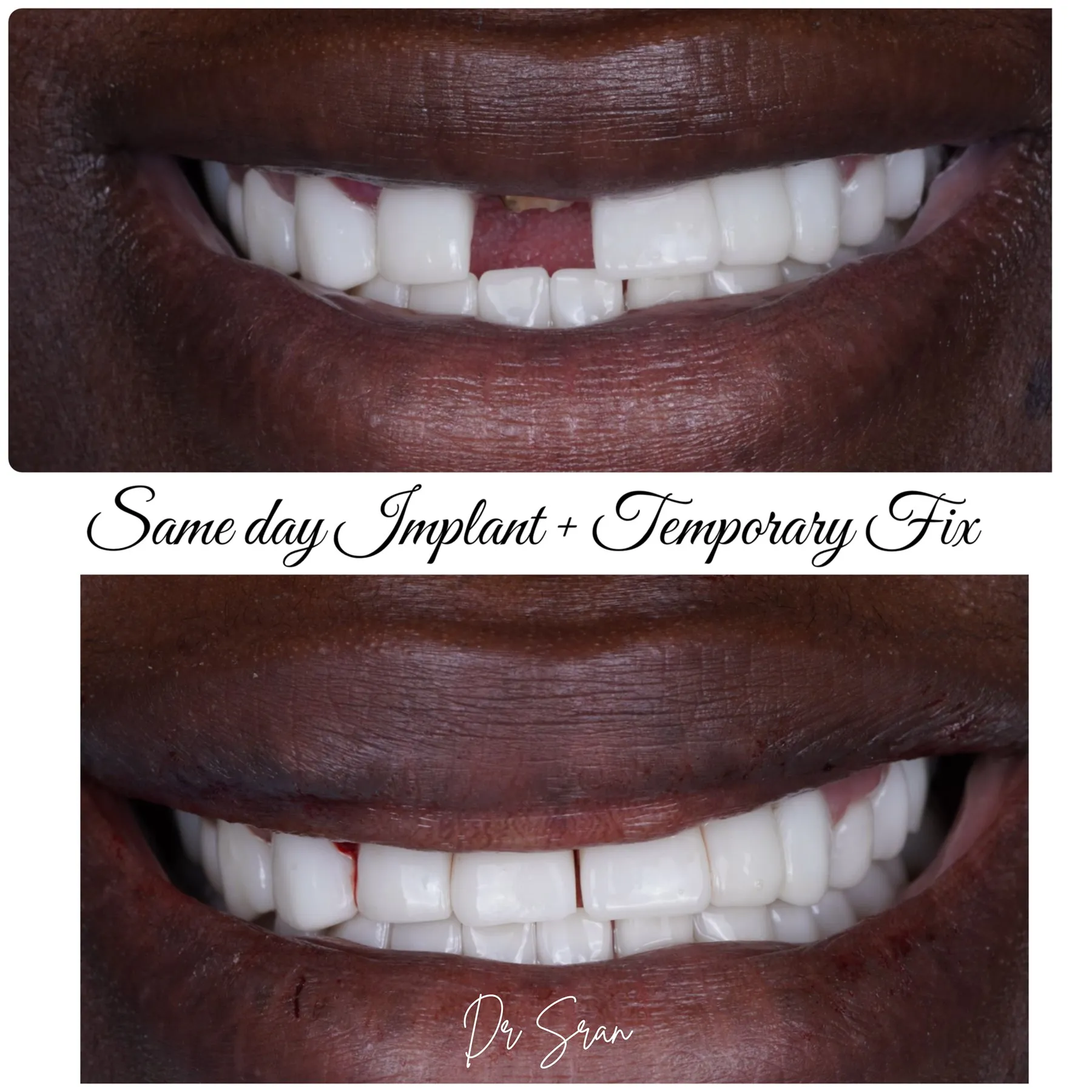 Real same-day implant result by Dr. Sran at Astra Dental