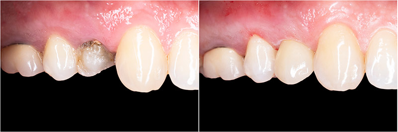 Same Day Teeth at Astra Dental in Stratford, CT
