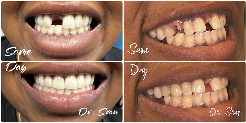 Same day dental restoration process at Astra Dental