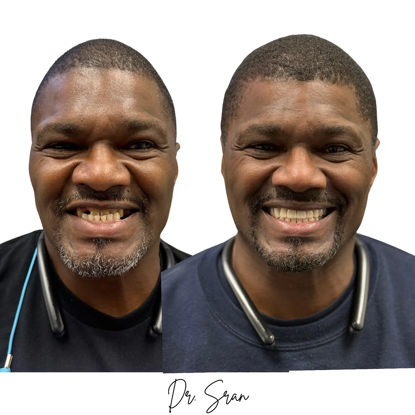 Implant zirconia transformation case photo from Astra Dental
