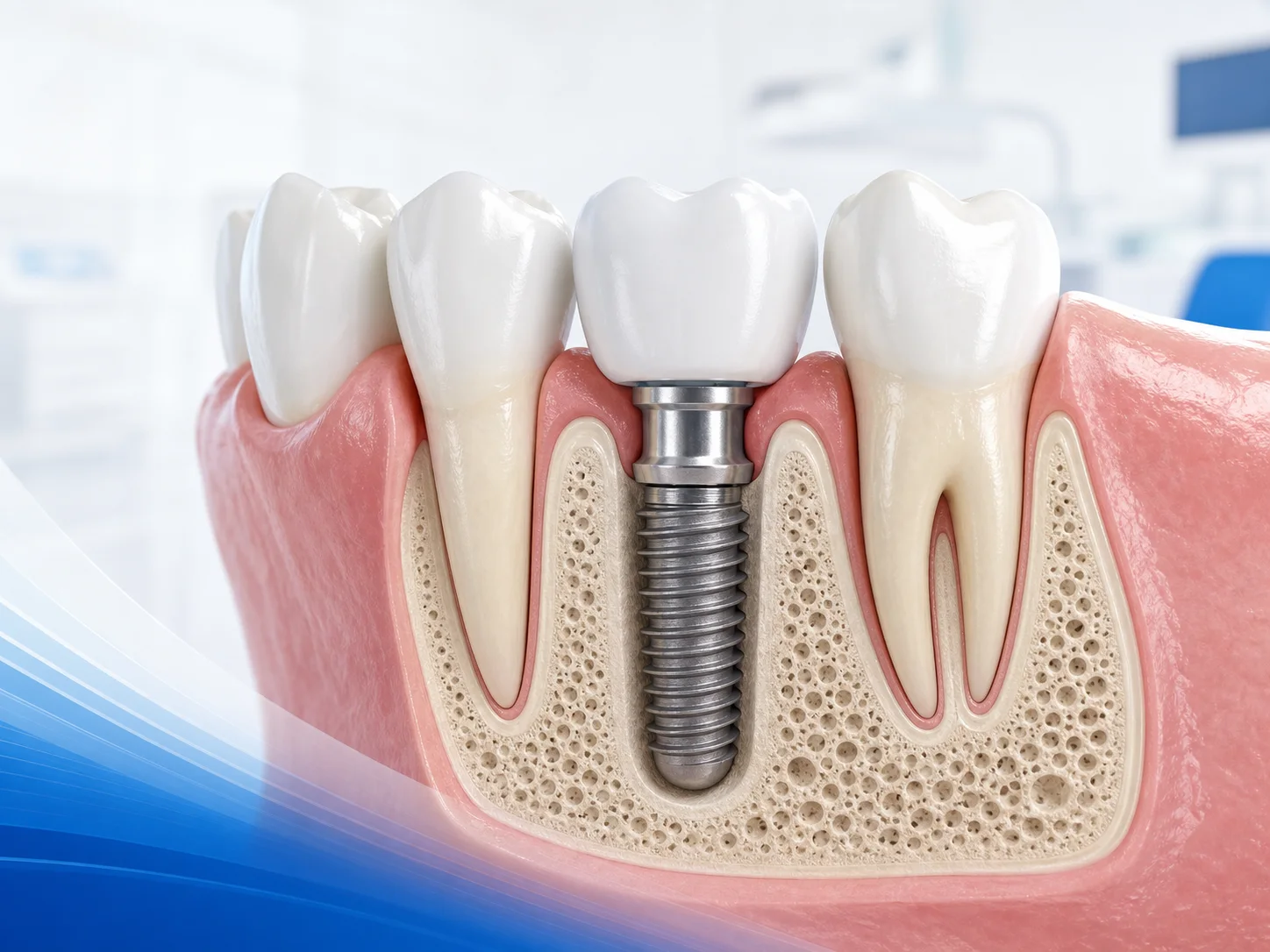 Considering Dental Implants? What to Expect at Astra Dental at Astra Dental